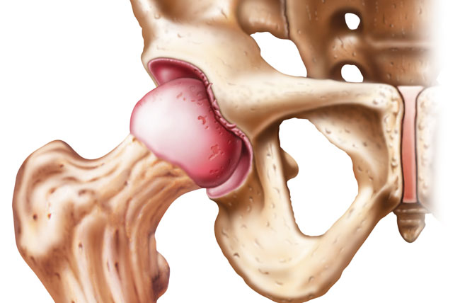 Torn shop labrum symptoms